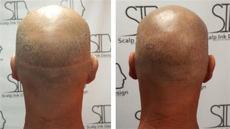 smp bugil|Scalp Micropigmentation in Miami 